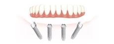 The All-on-4® treatment concept is a cost-efficient, graftless solution that provides patients with a fixed full-arch prosthesis on the day of surgery. 