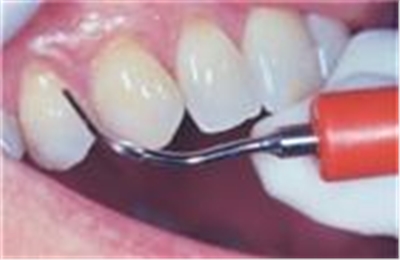 Teeth Scaling and Polishing